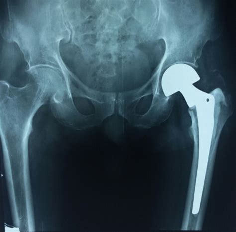 Case Study Hip Fracture Aaos Evidence Based Practice Guidelines