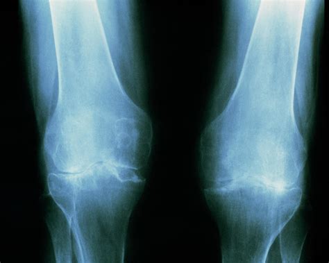 Tinted X Ray Of Rheumatoid Arthritis In The Knees Photograph By Medical Photo Nhs Lothian