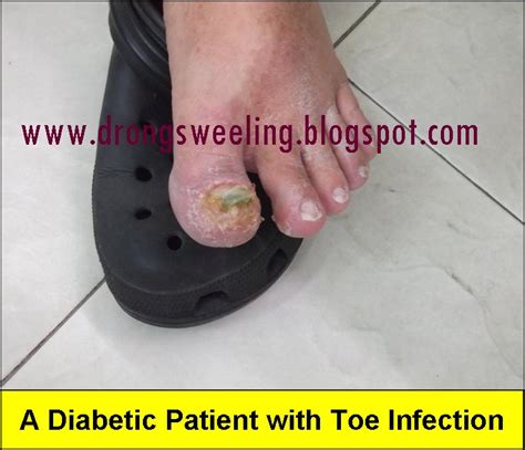 Tcm News A Diabetic Patient With Toe Infection