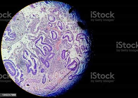 Microscopic View Of Histology Stained Slide Closeup Carcinoma Biopsy