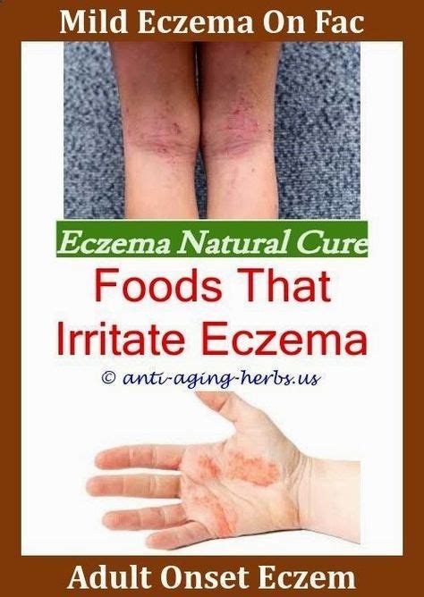 Eczema On Scalp Pompholyx Eczema Remedieseczema Dermatitis Treatment