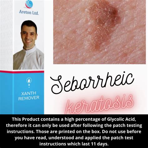 The Seborrheic Keratosis Removal Solution The Specialised Cosmetic