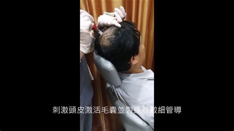 Mts Hair Regrow Treatment Youtube