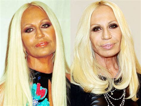 Donatella Versace Celebrity Plastic Surgery Disasters Pictures