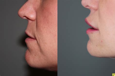 atlanta lip lift buckhead lip plastic surgeon benjamin c stong md