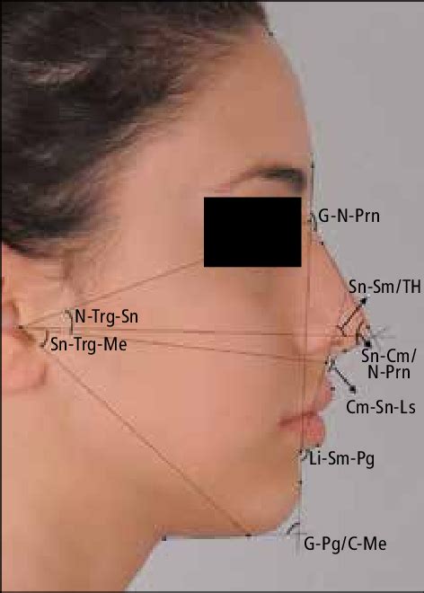 Angles Used In The Study Cm Sn Ls Nasolabial Angle G N Prn