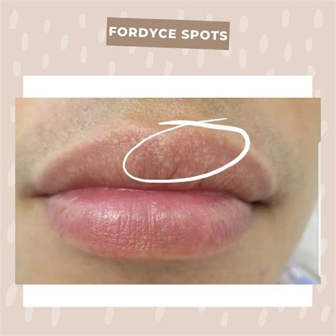 Fordyce Spots Symptoms Causes Treatment On Lips 54 Off