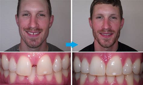 However, they are a lot more cosmetic and more comfortable. Invisalign: Closing the Gap