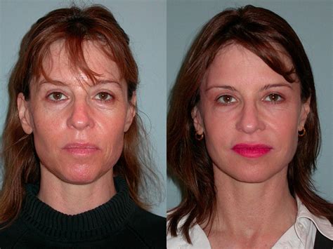 Sculptra Aesthetic Before And After