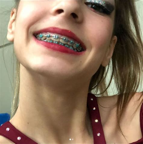 Pin By Evil H On Beautiful Braces Braces Girls Dental Braces