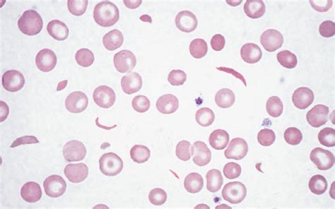 Sickle Cell Sickle Cell Anemia And Its Prevention Biology Science