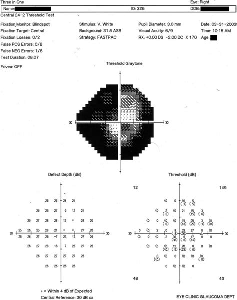 Humphreys Visual Field Chart Showing The Visual Field Damage In The
