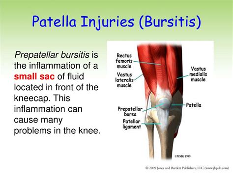 Ppt Trochanteric Bursitis Powerpoint Presentation Free