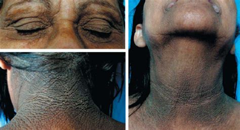 Patient Presenting Skin Thickening With Exaggerated Ridges And