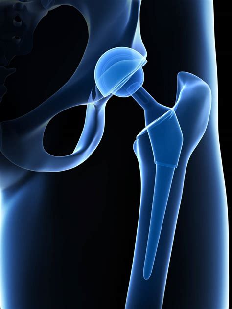 What is an Anterior Approach Total Hip Replacement Surgery? | Orlando ...