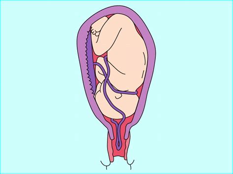 Rightatrium “ Prolapsed Cord Is When The Umbilical Cord Falls Down