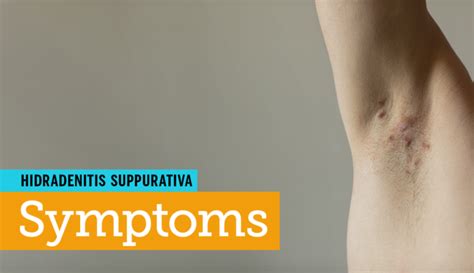 Your Guide To Hidradenitis Suppurativa Symptoms Treatments And More