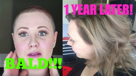 One Year Hair Growth From Bald Too Important Vlog Navigateur