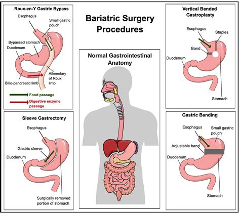 Cureus The Impact Of Bariatric Surgery On Cardiovascular Risk Factors