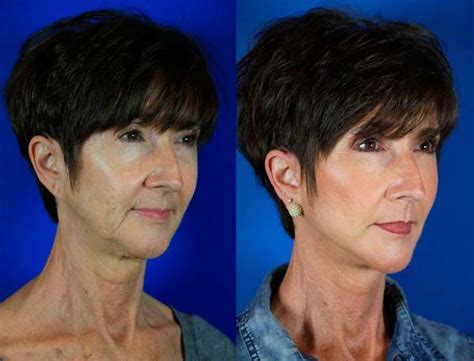 Georgia 60 Before And After Facelift Reflection Lift And Full Face