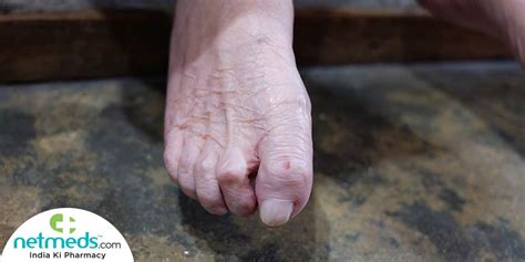 Claw Toe Causes Symptoms And Treatment