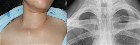 Sternoclavicular Joint Dislocation Treatment Captions More