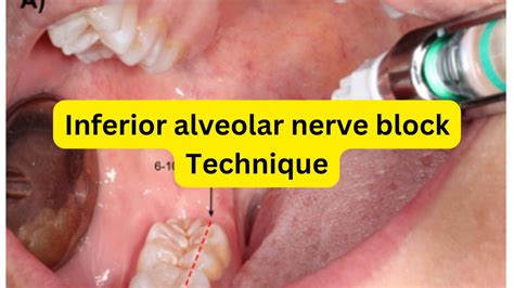 How To Give Inferior Alveolar Nerve Block Youtube