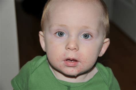 Toddler 14 Months Facial Rash Pacifier Teething Son Kids