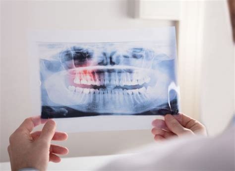 Wisdom Teeth Fairfield Nsw • Perfect Dental Fairfield