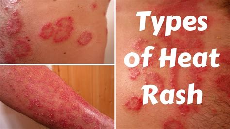 Any red eruption of the skin. Types of Heat Rash - YouTube