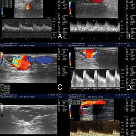 Angioplasty Of Stenosis In Dialysis Fistula Performed Under Ultrasound