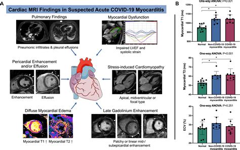 Cardiac Mri In Suspected Acute Covid 19 Myocarditis Radiology