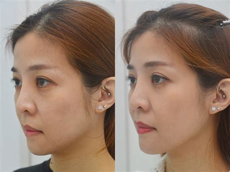 Ultherapy Review Singapore Non Surgical Skin Lifting And Firming