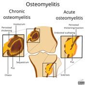Osteomyelitis Radiology Reference Article Radiopaedia Org