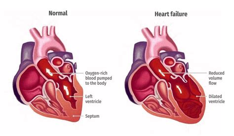 Illustration Of A Healthy Heart And One With Heart Failure Download