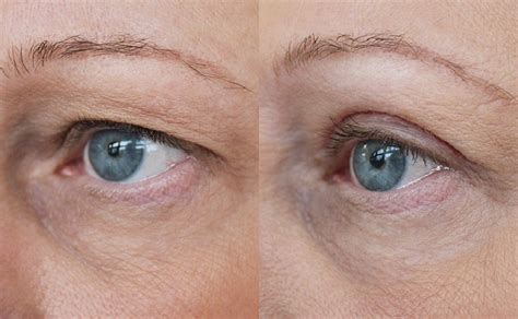 Cost Of Eyelid Surgery Or Blepharoplasty In Iran