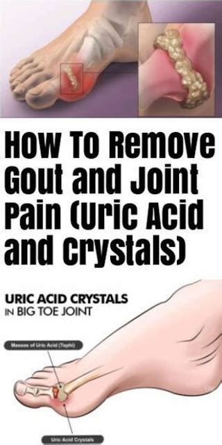 How To Quickly Remove Uric Acid Crystallization From Your Body To