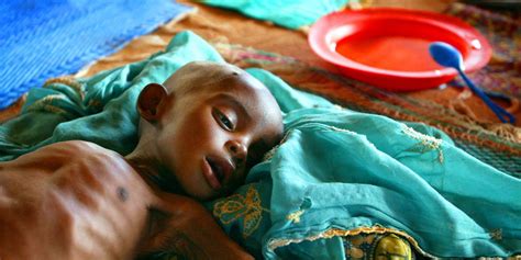 La Malnutrition Responsable De La Mort De Centaines D Enfants En Bas Ge Au Niger