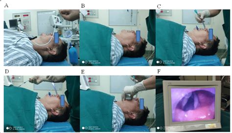 The Entire Process For Nasotracheal Intubation Using The Disposcope