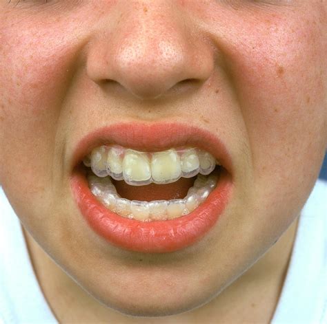 Tooth Brace Photograph By Alex Bartel Science Photo Library Pixels