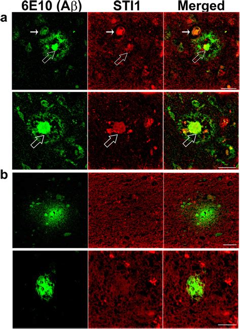 Dense Core Plaques In Human Alzheimers Patients Have Extracellular