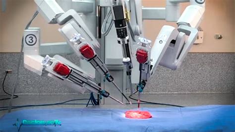 Actual Demo Of Robotic Surgery For Prostate Cancer Youtube