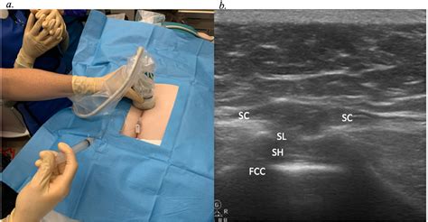 Ultrasound Guided Caudal Epidural Steroid Injection For Back Pain A
