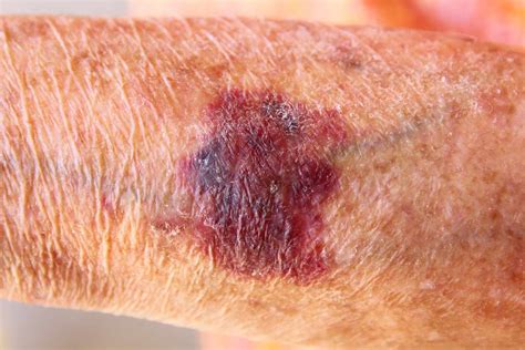 What Is Solar Purpura Bruising