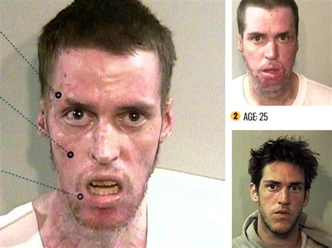 Methamphetamine Before And After Pictures Popularquotesimg