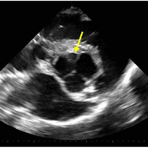 Cross Sectional Image Of The Cardiac Base Showing Quadricuspid Aortic