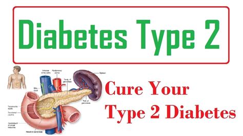 Diabetes Type 2 Permanent Cure How To Reverse Type 2 Diabetes