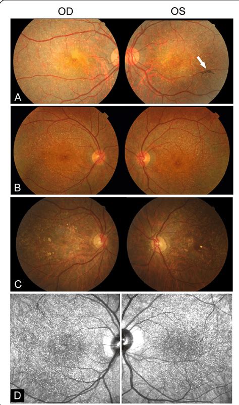 Color Fundus Photography And Infrared Images Of Three Patients With
