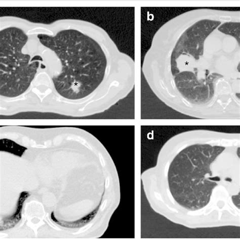 Lung Tumors Adjoining Different Structures In The Thorax A Only