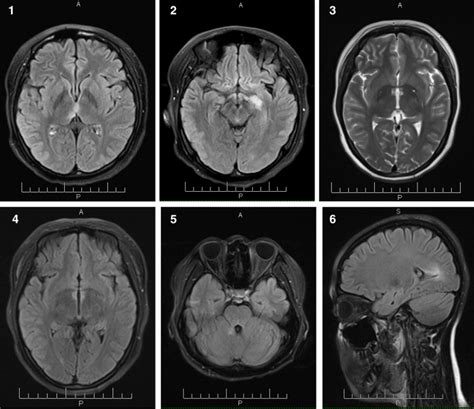Brain Mri Abnormalities In Neuromyelitis Optica European Journal Of
